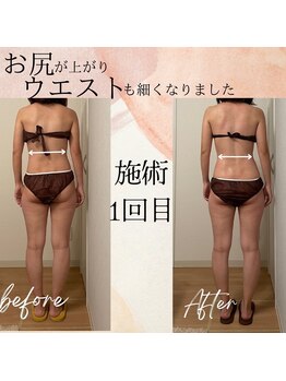 ラルーエ 仙台/全身筋膜痩身90分before→after