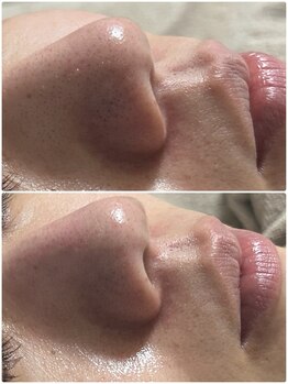 ルボーテ(Re beaute)/1回目《ララピール》