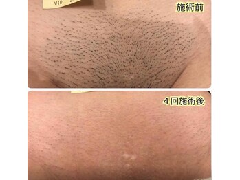 エアリアル 大牟田店/今話題の介護脱毛！