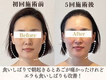 サロンキャン(Salon.CAN)/エラ食いしばり本格改善コース