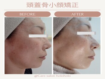 ホロホロ(holoholo)/頭蓋骨小顔矯正ビフォーアフター