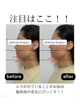 エミング(yeming)/美禅筋骨小顔TR！Before/After