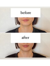 東京デトックス/インディバフェイシャル70分