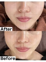 ベルファーム(Belle Femme)/小顔ケアならプラズマリフト♪