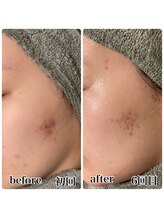 レピア つくば店(LEPIA)/6回ビフォーアフター