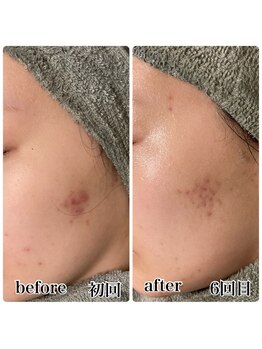 レピア つくば店(LEPIA)/6回ビフォーアフター