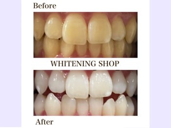 ホワイトニングショップ 守口店/before／After　16トーンUP