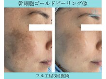 リメイククリニカルビューティー(Remake clinical beauty)/レーザーではなくなりません