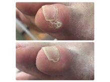 厚木 海老名 巻き爪矯正センター/事例【ドイツ式フットケア】
