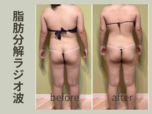 脂肪を分解してくれるラジオ派が登場！ペアでの同時施術も○