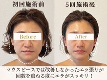 サロンキャン(Salon.CAN)/エラ食いしばり本格改善コース