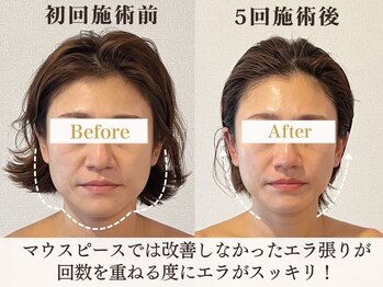 サロンキャン(Salon.CAN)/エラ食いしばり本格改善コース