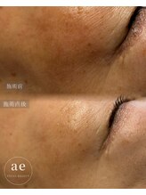 アエ(ae)/ダクトピール