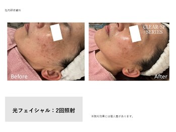エクラルム(Eclaleum)/BeforeAfter　光フェイシャル