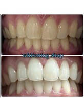 ホワイトニングショップ 池田店/【BEFORE/AFTER】
