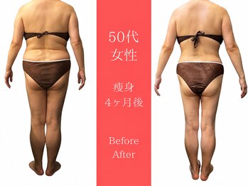 ムーン(MOON)/痩身全身before→after