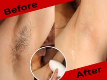 リムーブ(REMOVE)/【両わき脱毛】30代男性