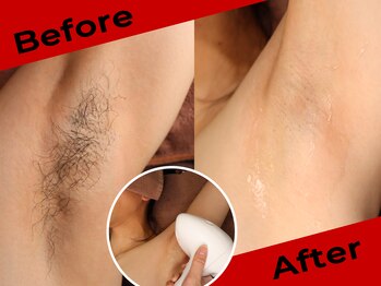 リムーブ(REMOVE)/【両わき脱毛】30代男性