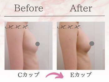 エムエムエム 表参道Luxeサロン(M.M.M)/【バストアップ例】　C→Eカップ