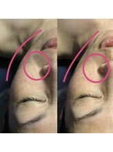 サロンココ(salon koko)/ラジオ波リフトＵＰフェイシャル