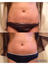 キラディ(KILADY)/諦めていたお腹周りもスッキリ！