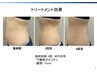 脂肪冷却【4カップ】＋ショックプレッシャー付　23,100円