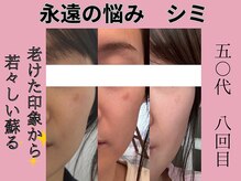 じぶんniプラスの雰囲気（諦めてたシミケア　シミケア　印象かわる最高級のプラズマケア）