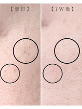 カンナ 福岡(Canna)/シミにお悩みの方