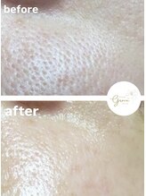 グレイス(Grace)/ハイドロ毛穴洗浄