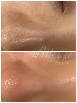 エルール トータルビューティ(Aileure total beauty)/VOSフェイシャル