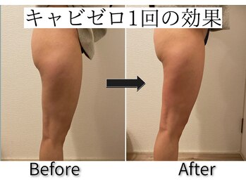 エトワール(etoile)/キャビテーション×EMS/痩身