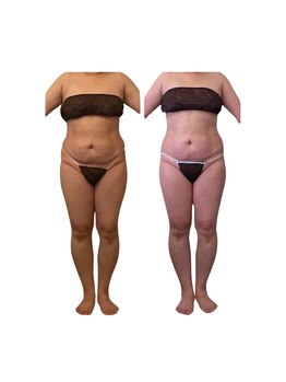 ソフィア わさだ店/セルゼロ半身コース