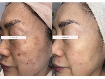 【シミ・肌質改善】L’aube allium ローブアリウム 芦屋　の写真/【もう隠しきれない…とお悩みの方へ】40代からの本格シミ改善＆予防ケア。年齢に負けない理想の素肌へ