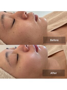 ルミエール(Lumiere)/２０代女性　高濃度美容液導入