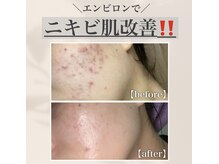 エイジング ラヴィーア 豊橋店(aging Lavia)の雰囲気（当店大人気の鎮静、ダメージの修復、保湿ができるパックです）