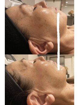 ディサイドロー(DECIDE L.A.W)/before after