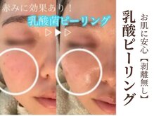 グラシーズ(Glasses)/高濃度乳酸ピーリングで美肌に♪