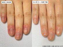 カピリナ(Ka Pilina)/自爪育成・深爪・川崎