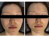 【人気No.2】切らないフェイスリフト小顔&頭蓋骨調整25000→5000