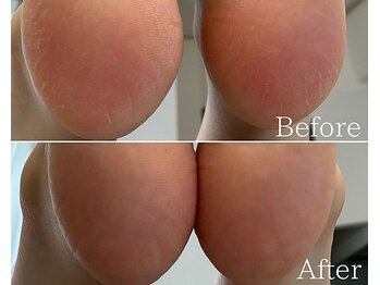 カシェット 広島店(Cachette)/30代女性☆足裏角質ケア40分