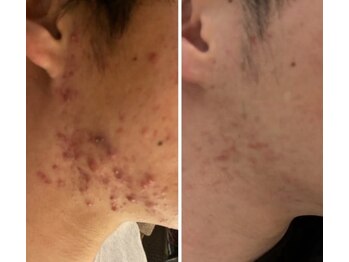 スリリアン 銀座/繰り返すニキビケアにはこれ!