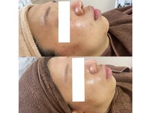 エステモ 札幌店(ESTEMO)の雰囲気（肌悩み根本改善！肌の土台から整え繰り返す肌悩みにアプローチ）