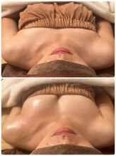 プリマ(prima)/バストアップ症例