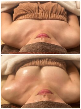 プリマ(prima)/バストアップ症例