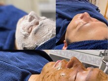 メンズ脱毛/フェイシャル/ハーブピーリング