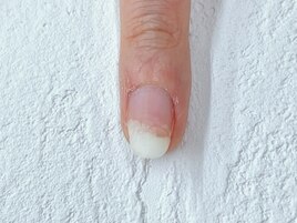 剥離した爪がキレイに見える
