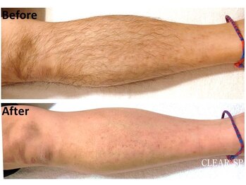 ユーフォリアプラス(euphoria +plus)/メンズ足脱毛