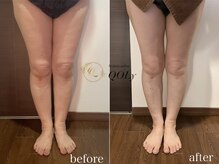 コリー(QOLy)の雰囲気（インディバボディで足の血流&浮腫み改善）
