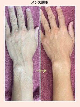 リファイン(REFINE)/ムダ毛対策！脱毛はエチケット♪