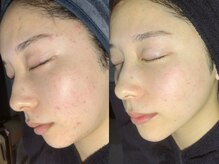 キー(kii)/肌を整えるハーブピーリング